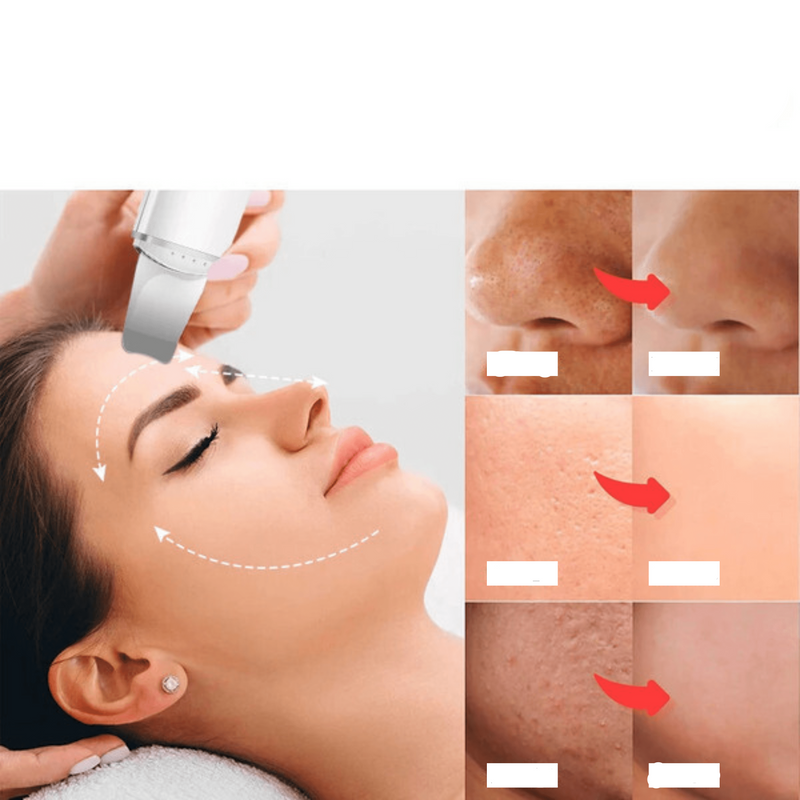 Ultrasonic Skin Scrubber: Blackhead Remover &amp; Facial Cleanser with Cavitation 