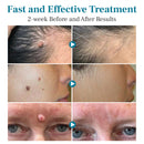 DAFEILA® LumeSkin Mole and Wart Removal Laser Pen 💙 8