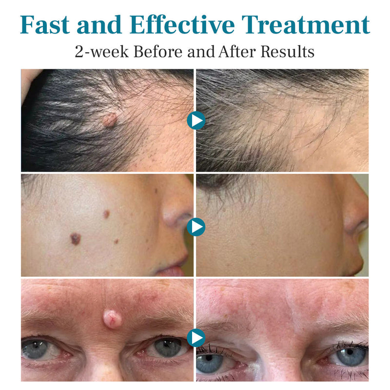 DAFEILA® LumeSkin Mole and Wart Removal Laser Pen 💙 8