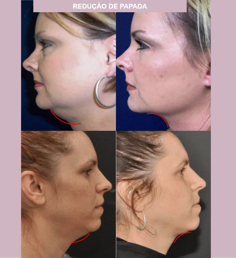 V-Revitalize™ - Facial Contouring Mask - Smoothes Wrinkles, Double Chins and Shapes the Face